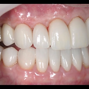 a visual of full mouth rehabilitation