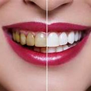 a visual of teeth whitening