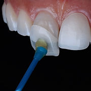 a visual of veneers