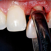 visual of teeth extraction