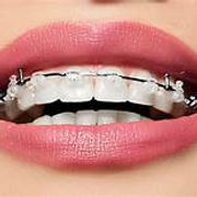 a visual of braces