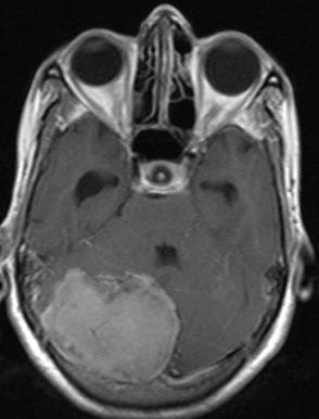 Ο 'Σιωπηλός Όγκος' του Εγκεφάλου...
