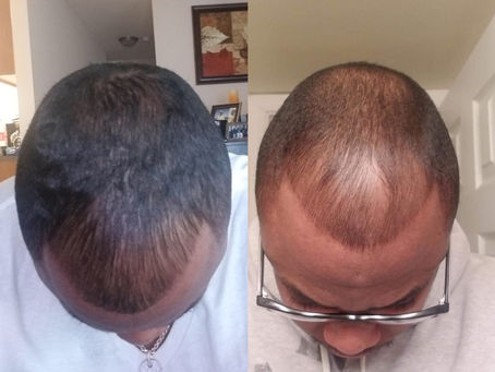 Are you having hair thinning problems?