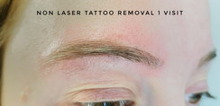 tattoo removal 1 session