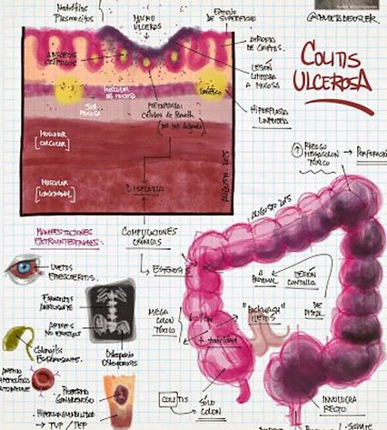 colitis