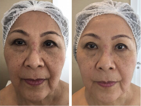 Protocolo rejuvenescedor Miotaping melhora performance muscular da face aliando massagem, faixas de calor e lifting