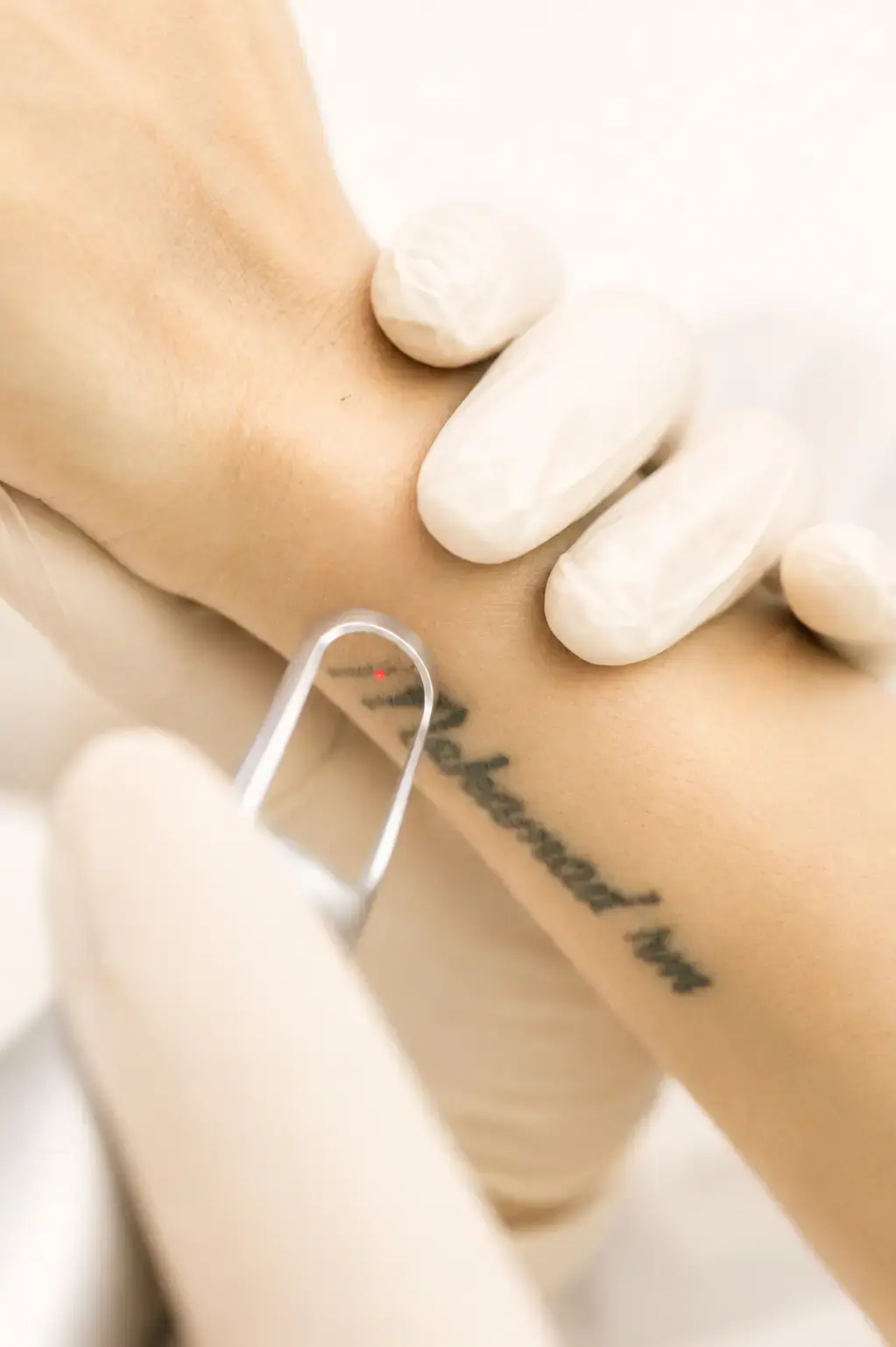 Tattoo removal is a procedure to remove unwanted tattoos. Eden Aesthetics Clinic offers this treatment in Dubai.