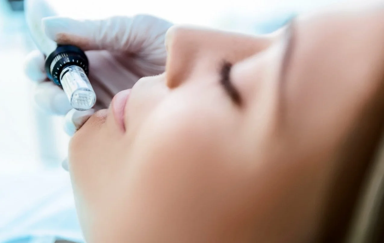 Dermapen-skin-needling-treatment-e1659794594144.webp