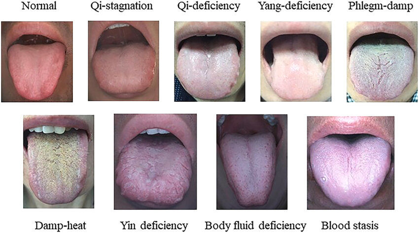 Tongue-image-of-nine-constitutions-in-traditional-Chinese-medicine.png
