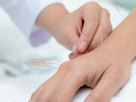 How Acupuncture Enhances Your Overall Wellbeing
