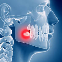 Wisdom teeth