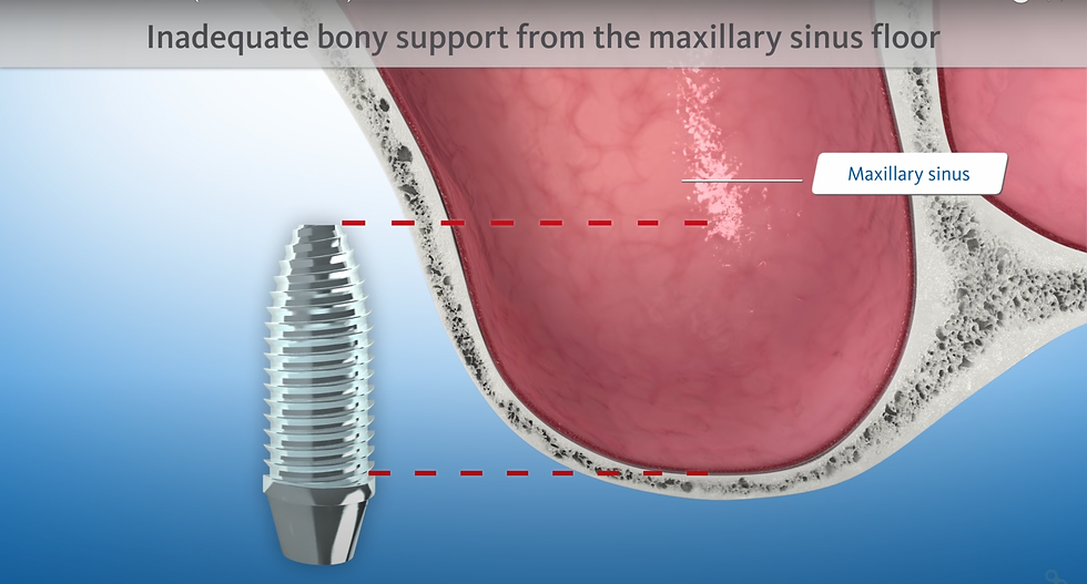 Lateral sinus lift