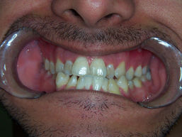 CLASS III IN ORTHODONTICS