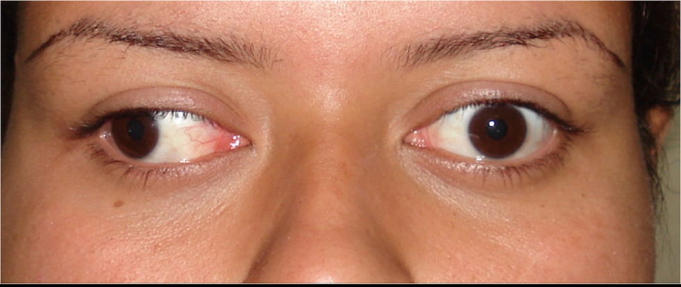 Paralisias oculares (neurogênicas e miogênicas) - AULA GRAVADA