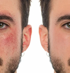 Microneedling before and after