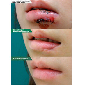 Lower lip scar revision and extension fixation with adhesive splint for about 6 months.
