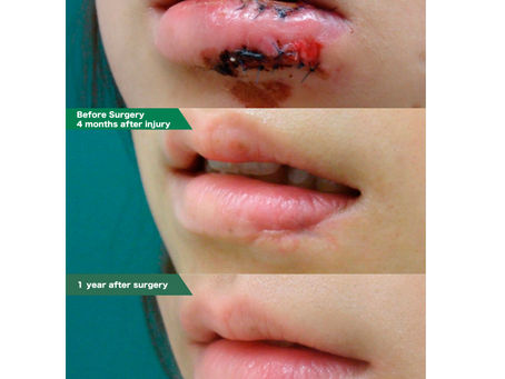 Lower lip scar revision and extension fixation with adhesive splint for about 6 months.