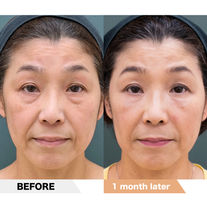 Lower eyelid groove under eyes, Smile lines, PRPF injection therapy