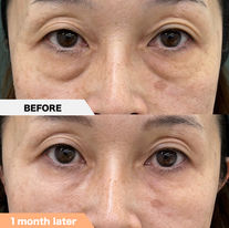 Tear trough, Lower eyelid groove under eyes ,PRPF®︎ injection therapy
