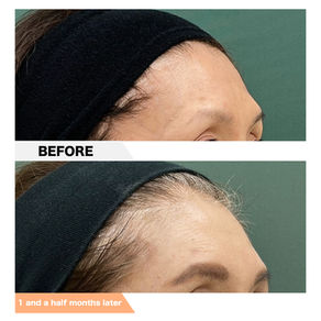 Forehead, PRPF Injection Therapy