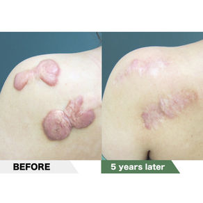 Left Shoulder keloid