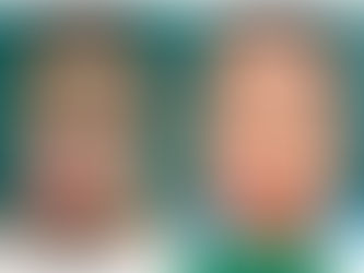 Keloids due to burns