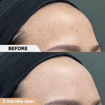 Forehead, PRPF Injection Therapy