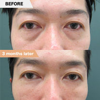 Lower eyelid groove under eyes, PRPF®︎ injection therapy