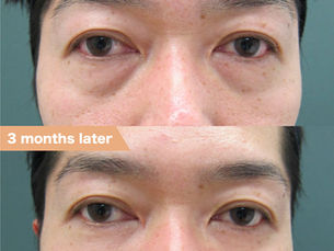 Lower eyelid groove under eyes, PRPF®︎ injection therapy