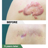 Left shoulder keloid