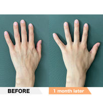 Hand wrinkles, PRPF®︎ injection therapy
