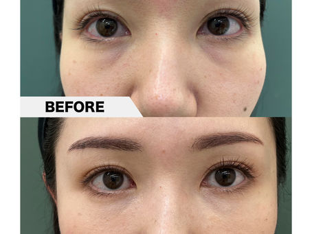 Tear trough, PRPF injection therapy