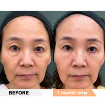 Lower eyelid groove + laugh lines PRPF Injection Therapy