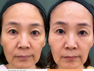 Lower eyelid groove + laugh lines PRPF Injection Therapy