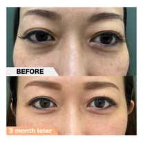 Tear trough, Dark Circle, PRPF®︎ injection therapy