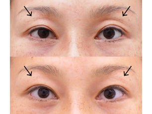 Sunken eye, PRPF injection therapy