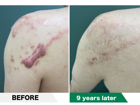 Scar contracture plasty (excision of true keloids, Z-plasty, 5-flap - repair with a combined design of multiple skin valves)