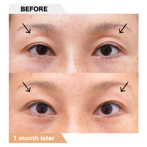 Sunken eye, PRPF injection therapy