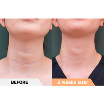 Lateral neck wrinkles, PRPF®︎ injection therapy