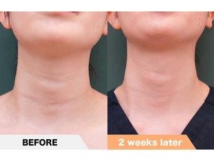 Lateral neck wrinkles, PRPF®︎ injection therapy