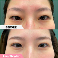 Revision of other hospital's burial method Total incisional blepharoplasty