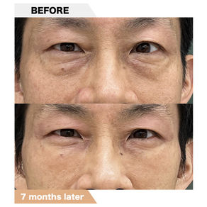 Lower eyelid groove under eyes, PRPF injection therapy