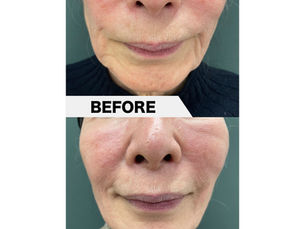 Laxity and sagging around the mouth, PRPF®︎ Injection Therapy