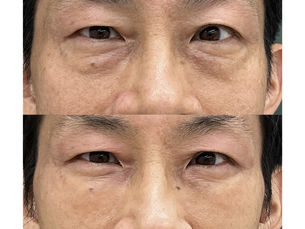 Lower eyelid groove under eyes, PRPF injection therapy