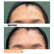 Forehead, PRPF®︎ Injection Therapy
