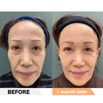 Forehead, Lower eyelid groove, nasolabial fold (laugh lines), and wrinkles between eyebrows,Marionette Line, PRPF®︎ Injection Therapy