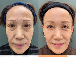Forehead, Lower eyelid groove, nasolabial fold (laugh lines), and wrinkles between eyebrows,Marionette Line, PRPF®︎ Injection Therapy