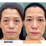 Lower eyelid groove under eyes, PRPF injection therapy