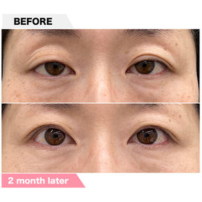 Ptosis+Blepharoplasty(Recovery surgery for cases from other hospitals)