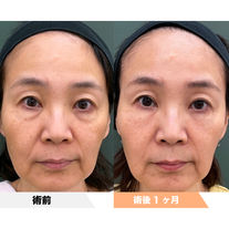 目の下のクマ+法令線 PRPF®︎注入療法